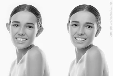 Abstehende Ohrenoperieren, EARFOLD®, Plastische Chirurgie Essen, Schönheitschirurgie Difine, Dr. Mustafa Narwan