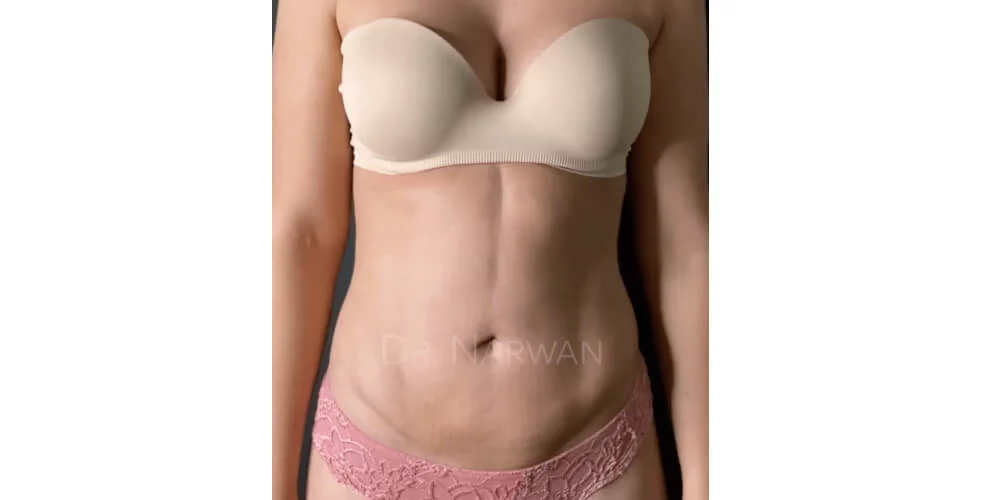 ergebnis-bauch-frau-sixpack-difine-essen-plastische-aestehtische-chirurgie-01.jpg 