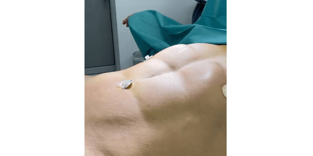 ergebnis-bauch-mann-sixpack-difine-essen-plastische-aestehtische-chirurgie-07.jpg 