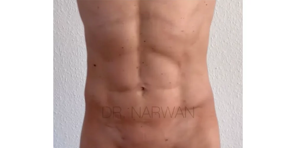 ergebnis-bauch-mann-sixpack-difine-essen-plastische-aestehtische-chirurgie-09.jpg 