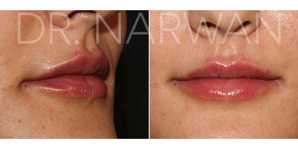 Lippenunterspritzung - Lippen aufspritzen » Hautarzt Dr. med