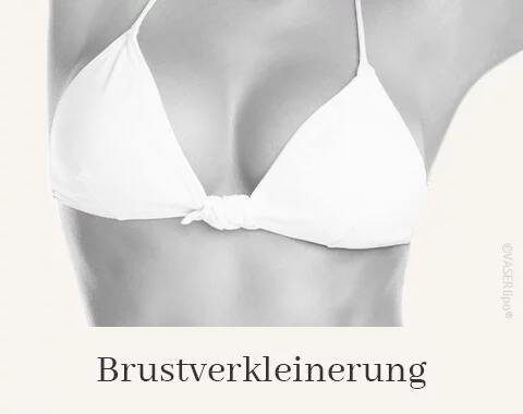 Brustverkleinerung, Difine, Dr. Narwan, Plastische Chirurgie Essen 