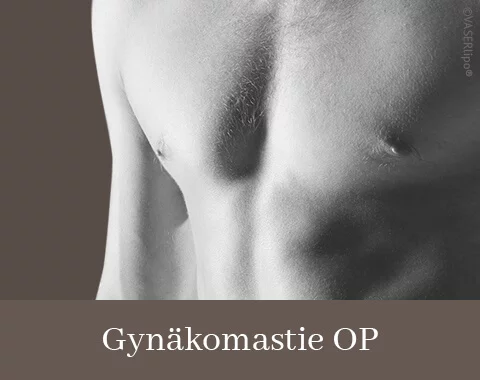 Gynäkomastie-OP, Difine, Dr. Narwan, Plastische Chirurgie Essen 