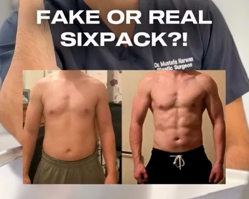 Fake or real Sixpack, Difine Düsseldorf, Plastische und Ästhetische Chirurgie