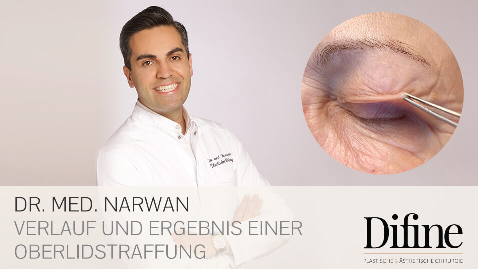 Augenlidstraffung, Plastische Chirurgie Essen, Schönheitschirurgie Difine, Dr. Mustafa Narwan