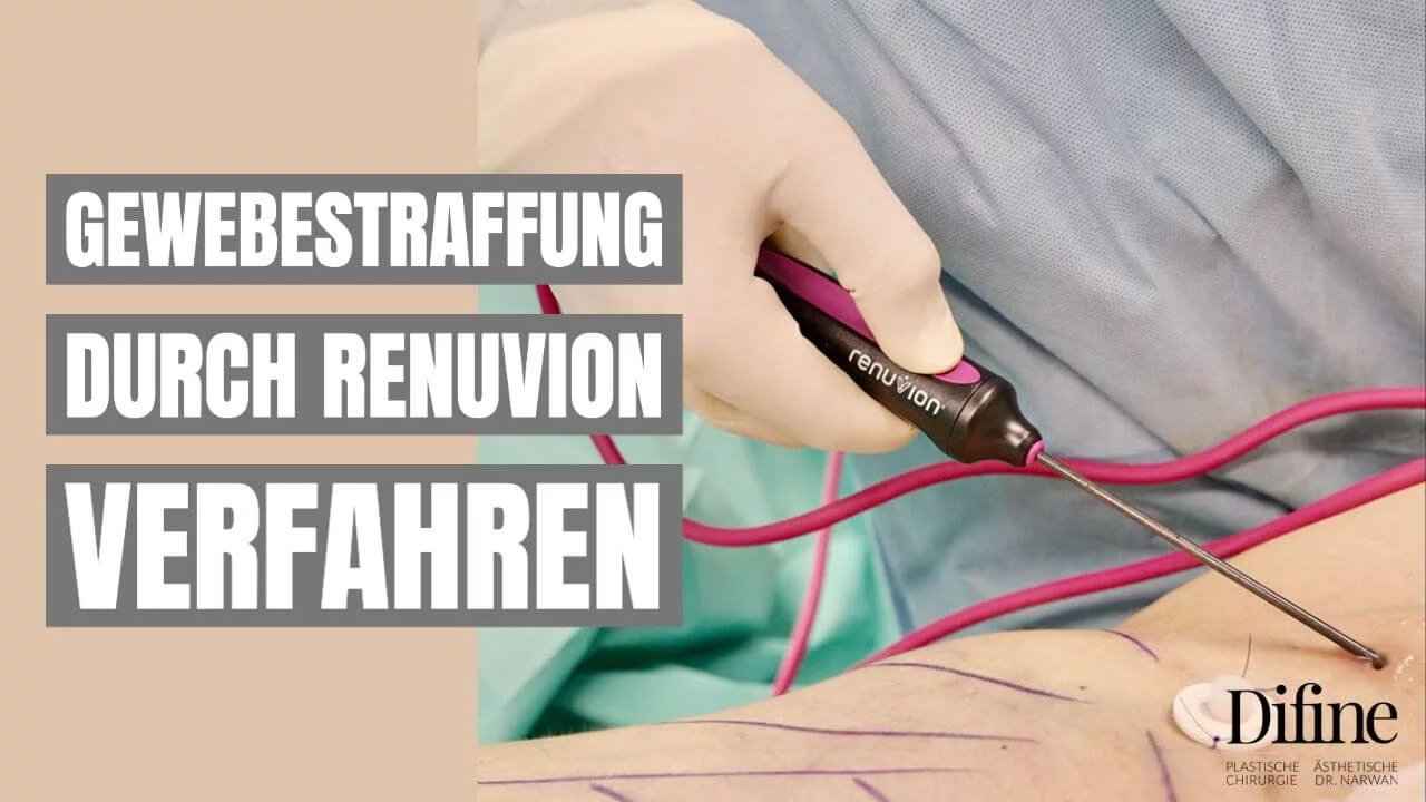 Gewebestraffung Renuvion, Plastische Chirurgie Essen, Schönheitschirurgie Difine, Dr. Mustafa Narwan