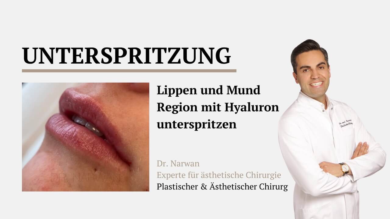 Unterspritzung Lippen und Mund, Plastische Chirurgie Essen, Schönheitschirurgie Difine, Dr. Mustafa Narwan