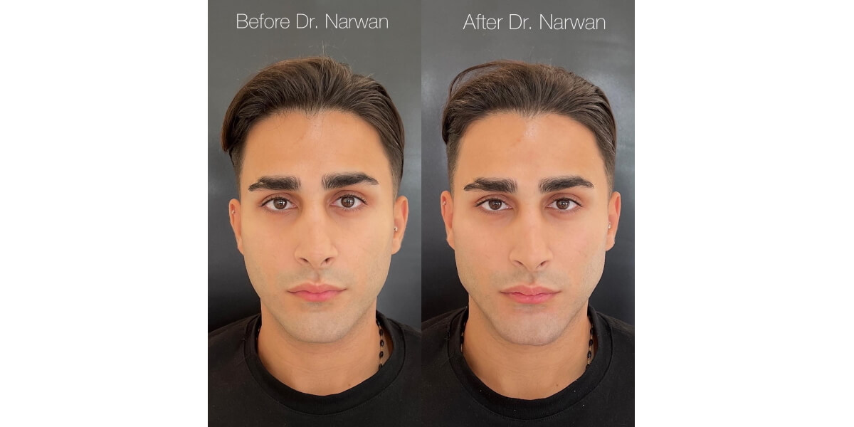 faltenunterspritzung-vorher-nachher-01-dr-narwan-plastische-aesthetische-chirurgie-essen.jpg 