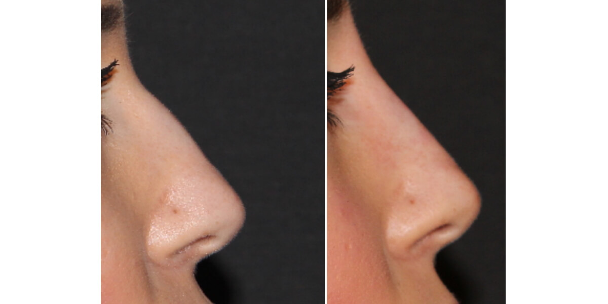faltenunterspritzung-vorher-nachher-02-dr-narwan-plastische-aesthetische-chirurgie-essen.jpg 