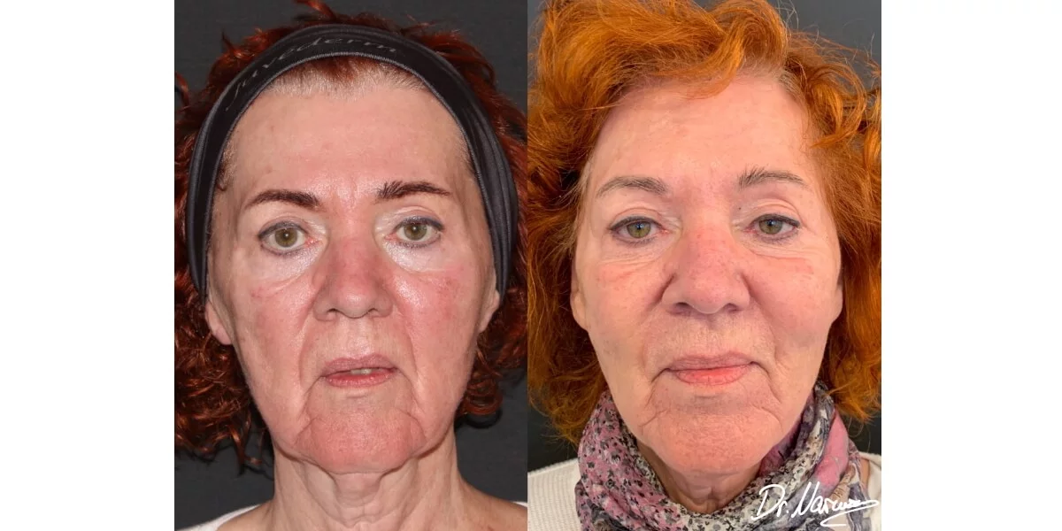 faltenunterspritzung-vorher-nachher-03-dr-narwan-plastische-aesthetische-chirurgie-essen.jpg 