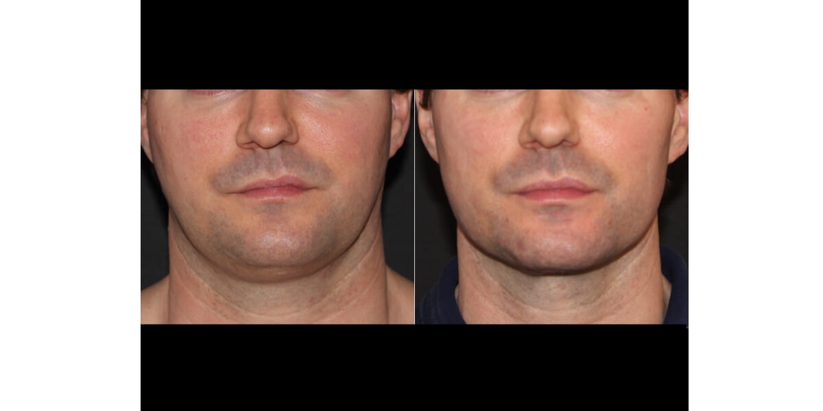 faltenunterspritzung-vorher-nachher-04-dr-narwan-plastische-aesthetische-chirurgie-essen.jpg 
