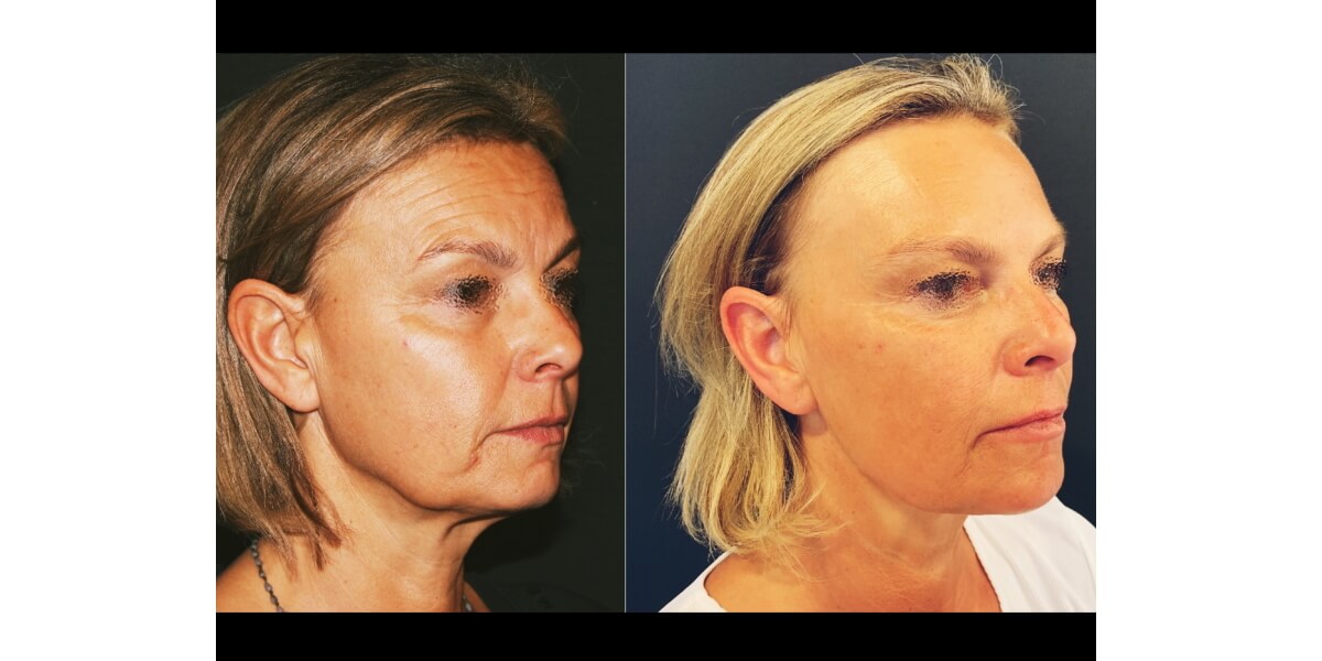 faltenunterspritzung-vorher-nachher-05-dr-narwan-plastische-aesthetische-chirurgie-essen.jpg 