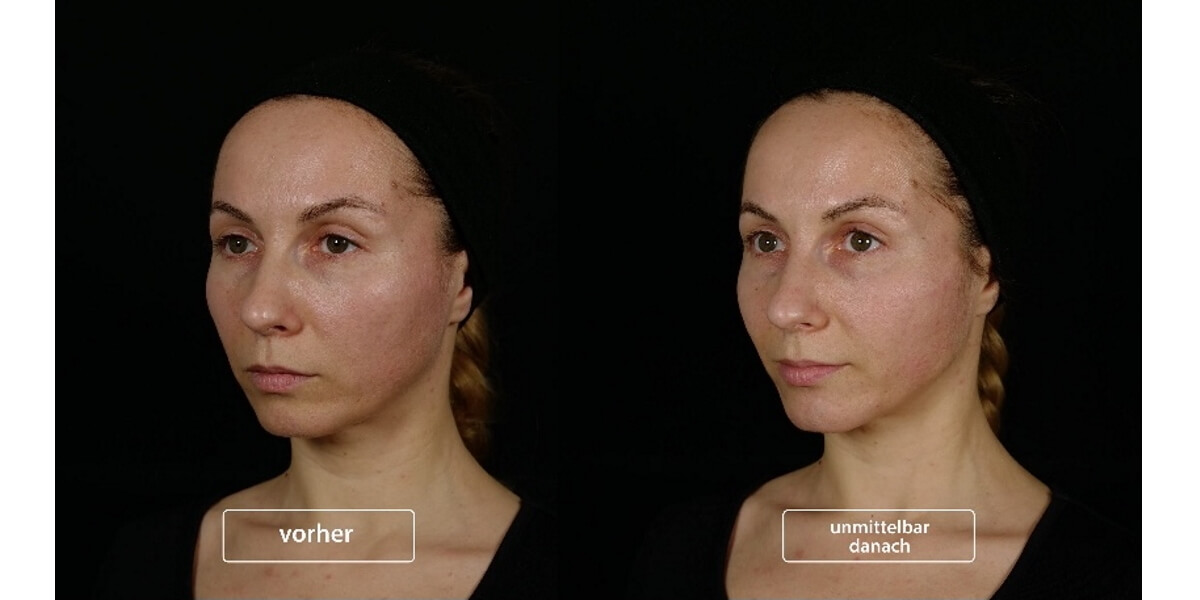 faltenunterspritzung-vorher-nachher-06-dr-narwan-plastische-aesthetische-chirurgie-essen.jpg 