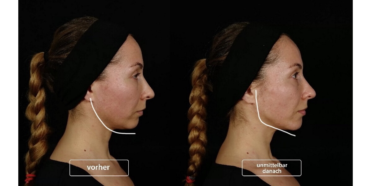 faltenunterspritzung-vorher-nachher-07-dr-narwan-plastische-aesthetische-chirurgie-essen.jpg 