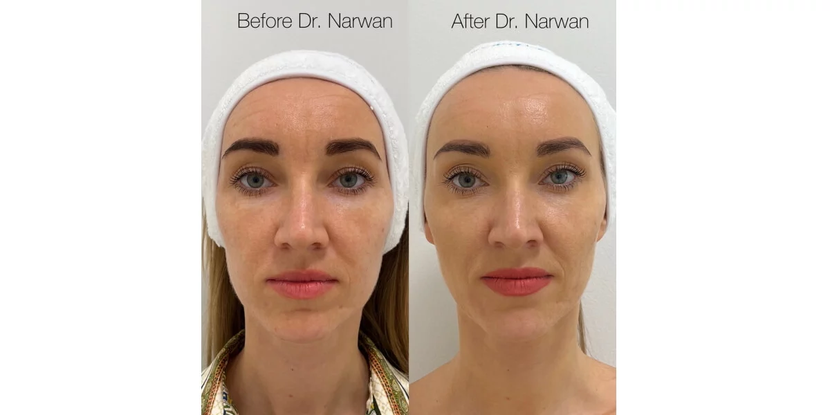 faltenunterspritzung-vorher-nachher-10-dr-narwan-plastische-aesthetische-chirurgie-essen.jpg 