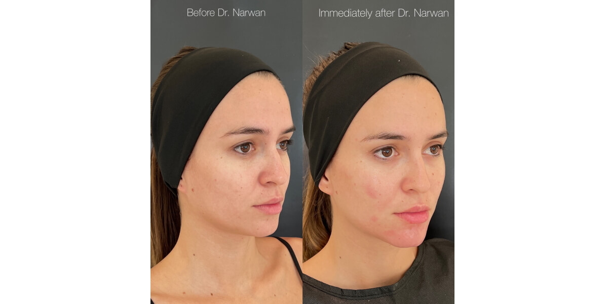 faltenunterspritzung-vorher-nachher-11-dr-narwan-plastische-aesthetische-chirurgie-essen.jpg 
