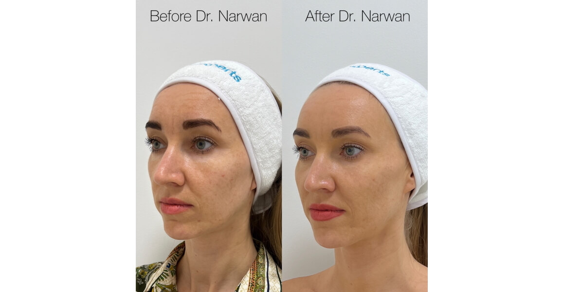 faltenunterspritzung-vorher-nachher-12-dr-narwan-plastische-aesthetische-chirurgie-essen.jpg 