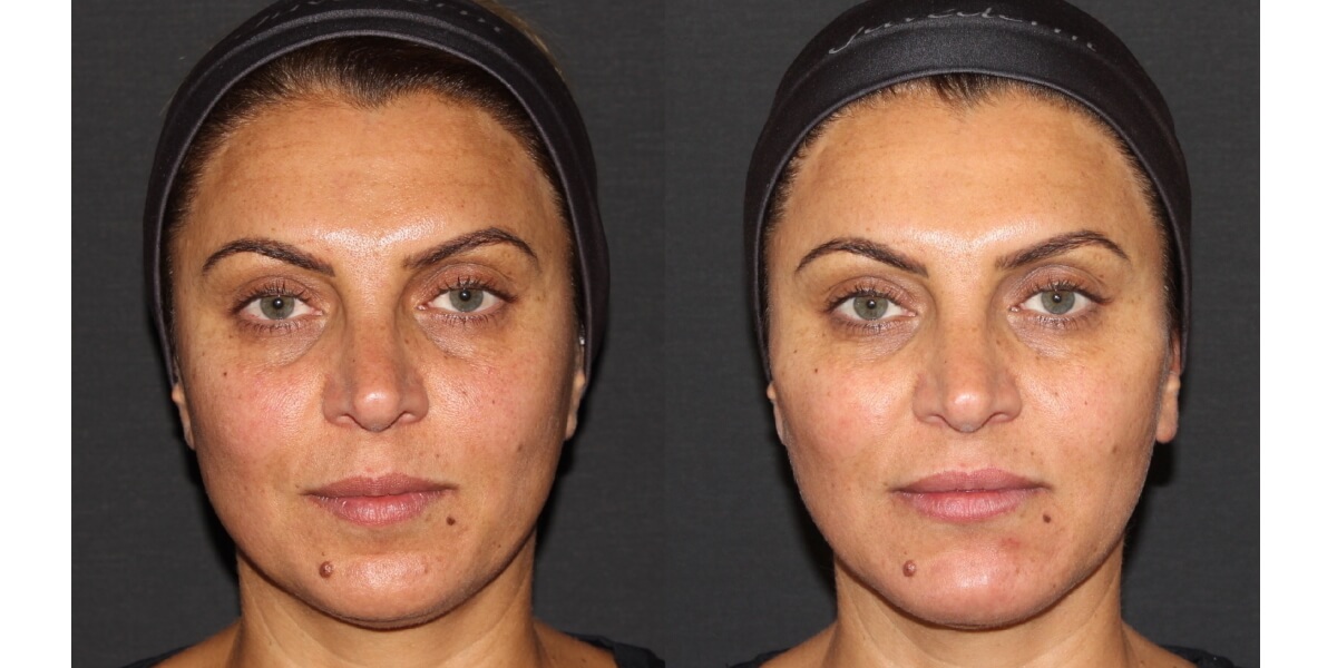 faltenunterspritzung-vorher-nachher-13-dr-narwan-plastische-aesthetische-chirurgie-essen.jpg 