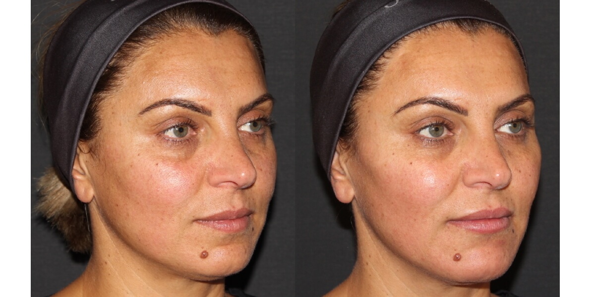 faltenunterspritzung-vorher-nachher-14-dr-narwan-plastische-aesthetische-chirurgie-essen.jpg 