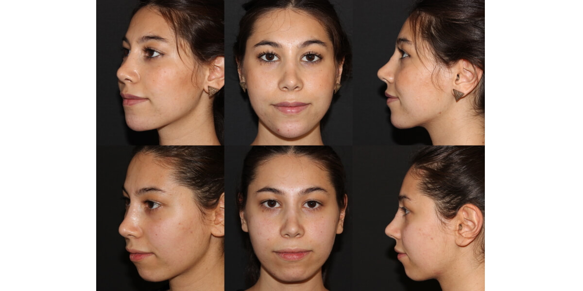 faltenunterspritzung-vorher-nachher-15-dr-narwan-plastische-aesthetische-chirurgie-essen.jpg 