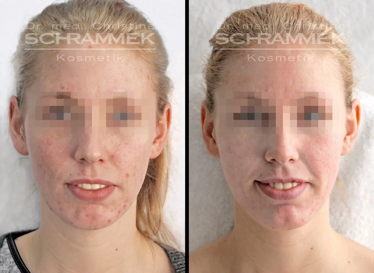 green-peel-vorher-nachher-04-dr-narwan-plastische-aesthetische-chirurgie-duesseldorf.jpg 